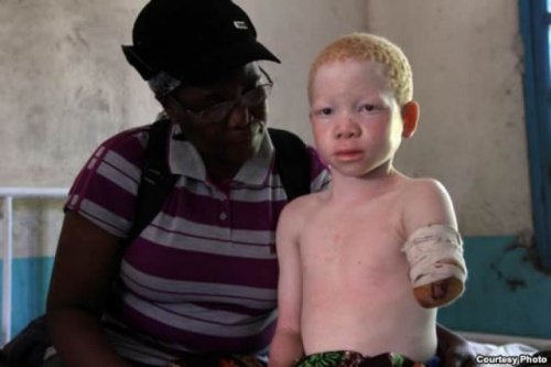 A realidade do albinismo na África