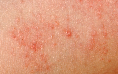 Alergias na pele