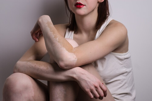 Quais-sao-as-causas-do-vitiligo-500x331