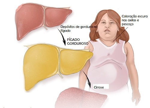 figado-gorduroso