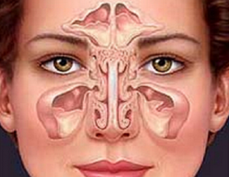 Como tratar a sinusite de forma natural?