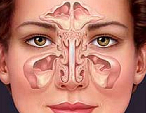Como tratar a sinusite de forma natural?