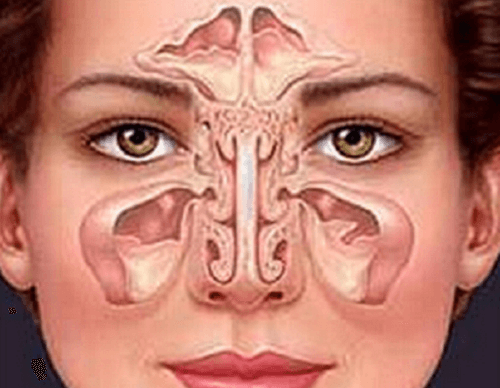 Como tratar a sinusite de forma natural? Como tratar a sinusite de forma natural?