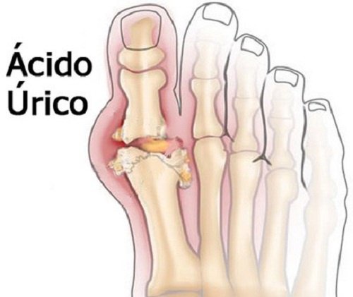 ácido úrico ou gota