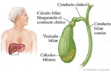Como eliminar pedras da vesícula naturalmente