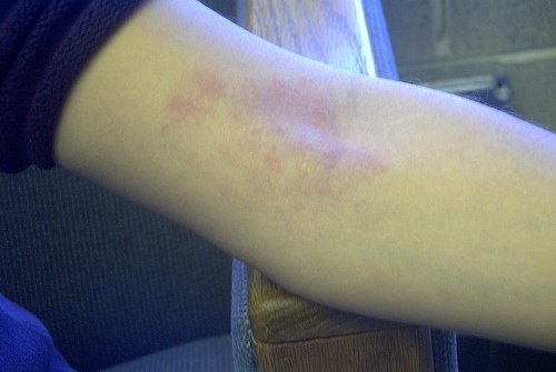 Dermatite no braço