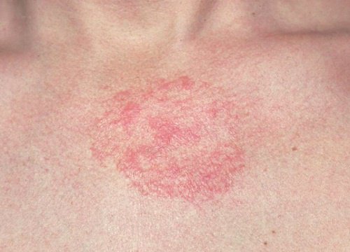 5 remédios caseiros para as dermatites
