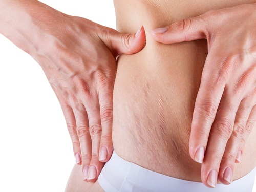 6 receitas eficazes para amenizar as estrias