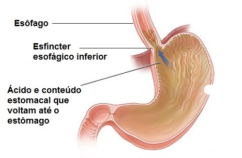 Conselhos e remédios naturais para tratar o refluxo gástrico