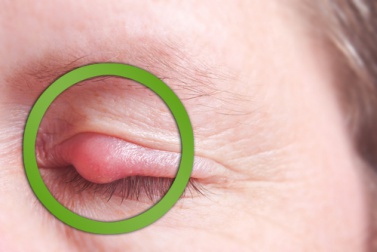 Terçol-nos-olhos-377x252