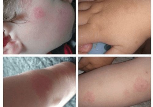 Cuidado com os carrapatos! Conheça a doença de Lyme e seus riscos