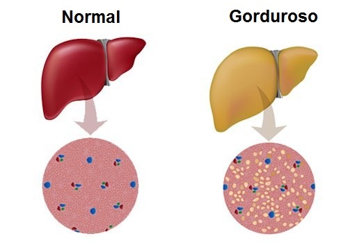 figado-gorduroso