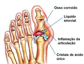 Diga adeus à gota com este potente tratamento natural