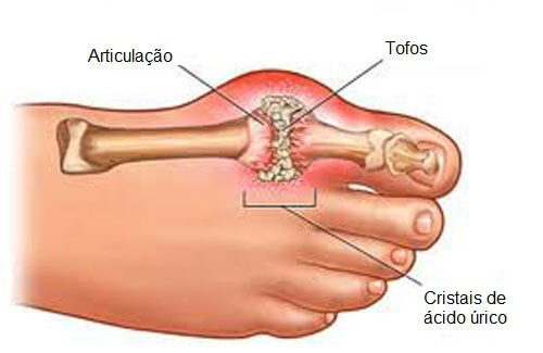 gota nas articulações