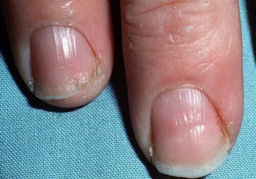 problemas da tireoide