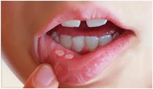 Aftas e úlceras bucais: Como trata-las de maneira natural