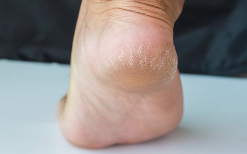 4 cremes caseiros para tratar calcanhares secos e rachados