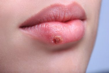 Por que a herpes labial sempre se repete?