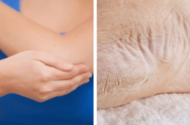Recupere os pés e cotovelos ressecados