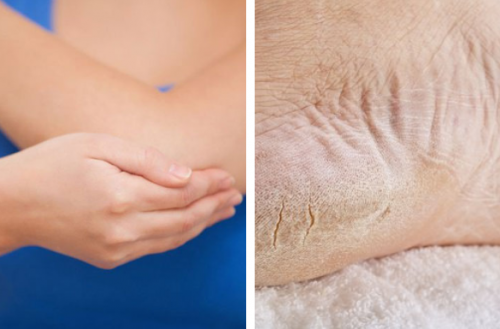Recupere os pés e cotovelos ressecados