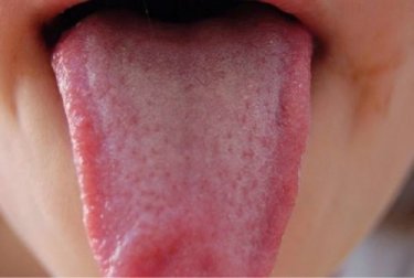 Remédios naturais para desinfetar a língua de maneira natural