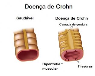 Doença de Crohn: tudo sobre uma dieta adequada