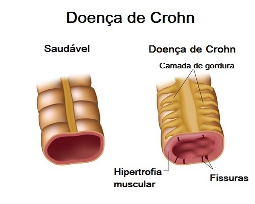 Doença de Crohn: tudo sobre uma dieta adequada