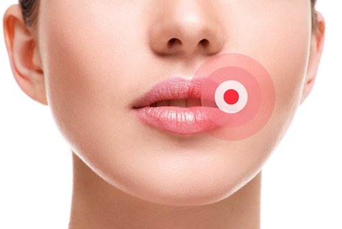 mulher que precisa tratar a herpes labial