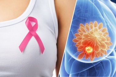 10 sinais que podem indicar um câncer de mama