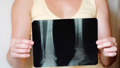 Como manter a densidade óssea ao chegar na menopausa