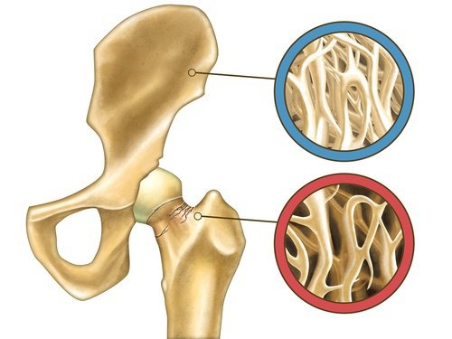 Ilustração de problemas nos ossos causado por falta de cloreto de magnésio
