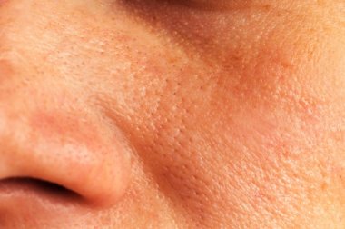 5 soluções naturais para reduzir os poros dilatados da pele