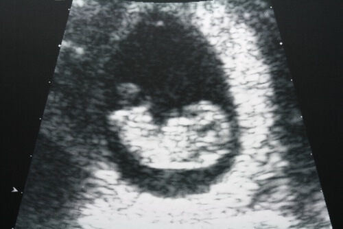 os sangramentos vaginais