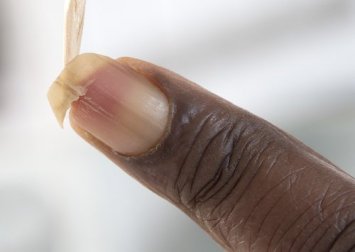 Como fortalecer as unhas quebradiças