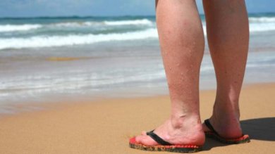 Conselhos para reduzir o incômodo das varizes no verão