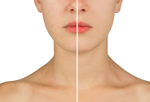 Combater a acne com água oxigenada