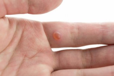 Como eliminar as verrugas da pele sem deixar cicatriz
