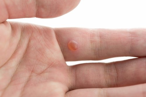 Como eliminar as verrugas da pele sem deixar cicatriz