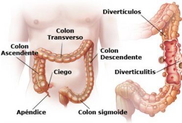 Diverticulite e diverticulose: o que são e como se tratam?
