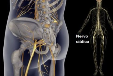 Tratamentos para aliviar as dores do nervo ciático