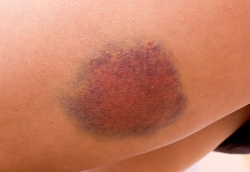 Hematomas