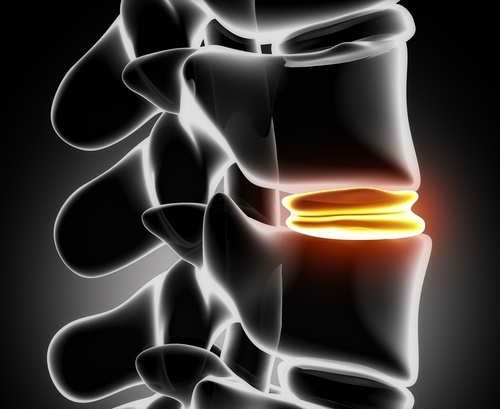 hernia-de-disco