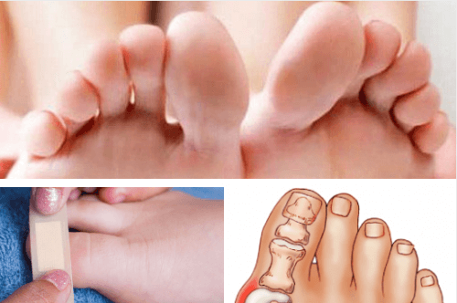Lesões e doenças dos dedos dos pés: saiba como tratá-las!