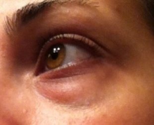 Como reduzir as olheiras naturalmente