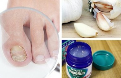 7 remédios caseiros para combater os fungos nas unhas