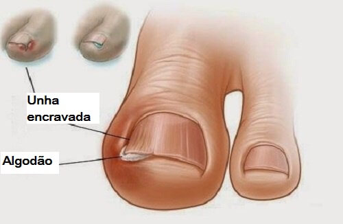 6 remédios ancestrais para aliviar as unhas encravadas 6 remédios ancestrais para aliviar as unhas encravadas