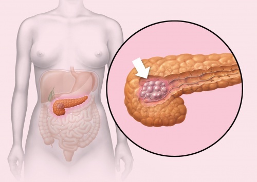 Câncer de pâncreas pode se tornar o segundo com maior mortalidade