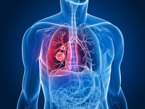 Cancer-de-pulmão