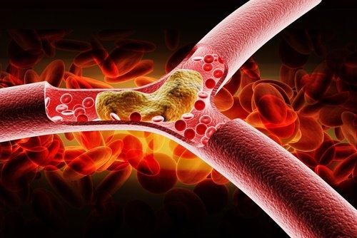Arteria-com-colesterol