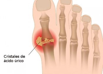 Ácido úrico: o que é e como controlá-lo